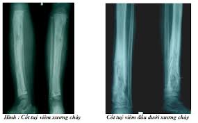 Giảm độ đặc xương - Hình ảnh minh họa